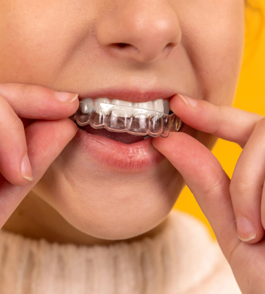 Close-up of a person inserting a clear dental aligner onto their teeth with their fingers.